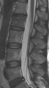 MRT LWS mit isolierter Metastase LWK 2