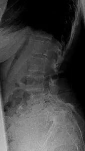 Ventro-dorso-ventrale Spondylodese LWK4-SWK1